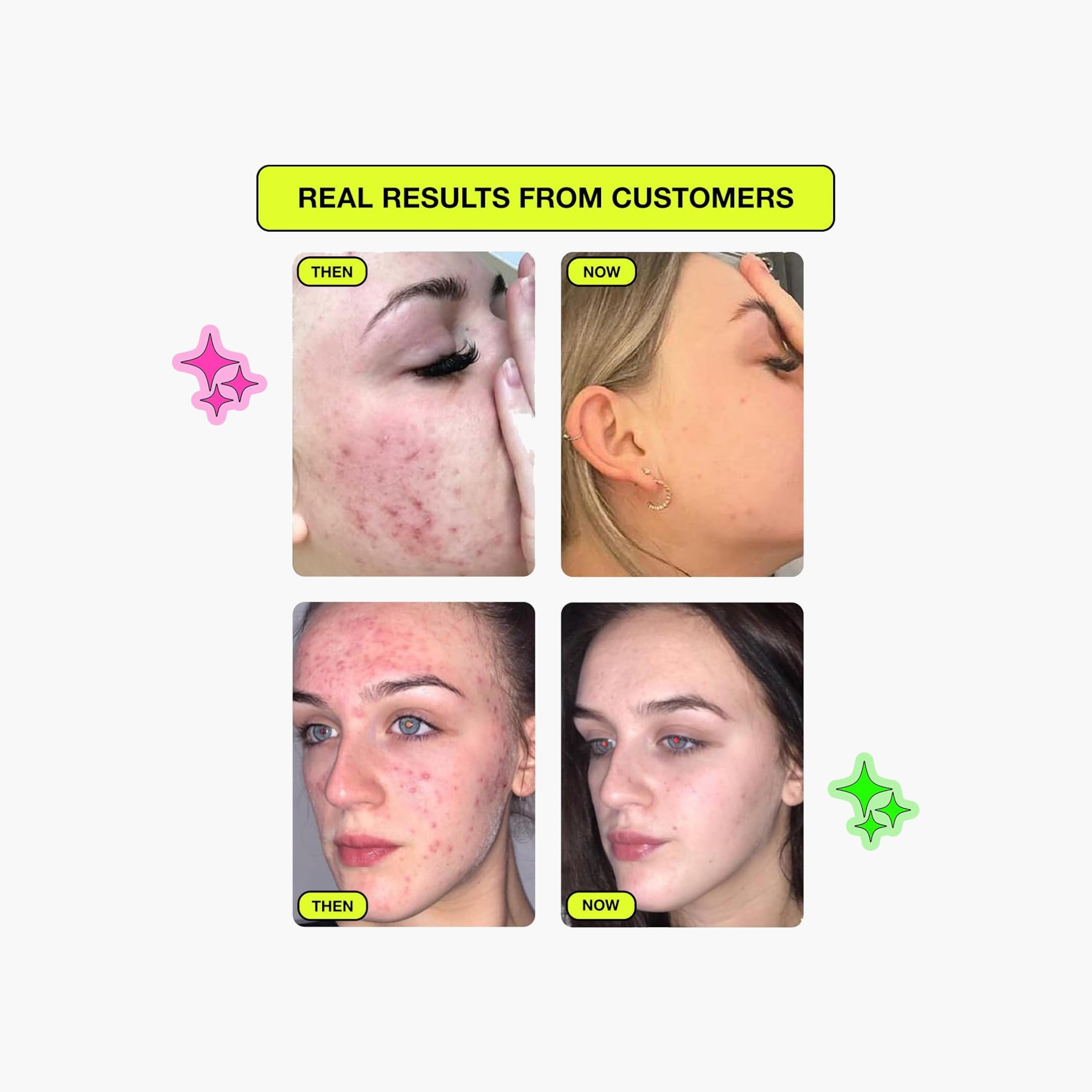 لصقات حمض الساليسيليك من كاربون ثوري-beautyandpersonalcare-skin-masks-facepads-image-3