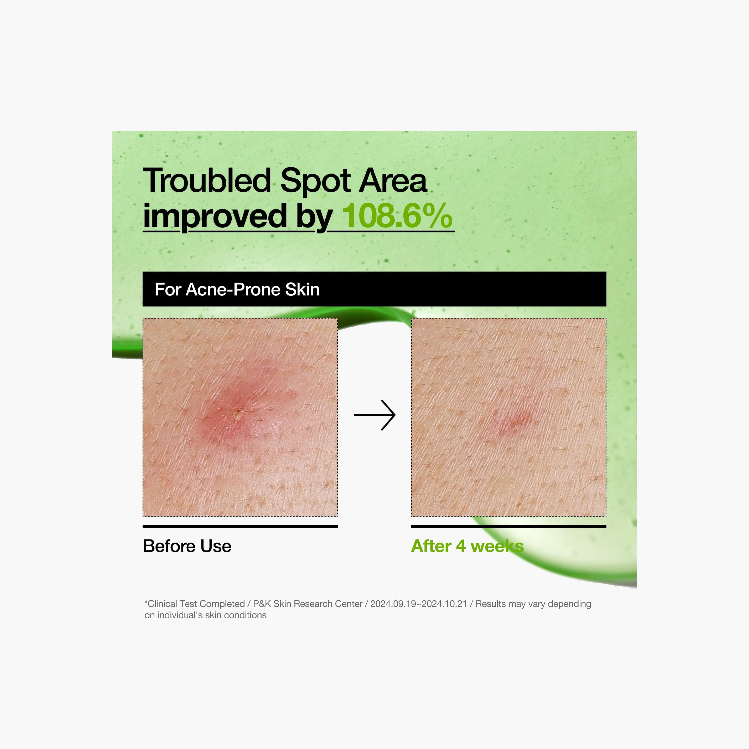 مصل مهدئ للاحمرار بحمض الأزيليك من أنوا-beautyandpersonalcare-kbeauty-skin-treatmentsandserums-image-3
